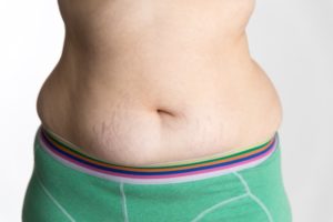 Was tun bauch hängender hängender Bauch