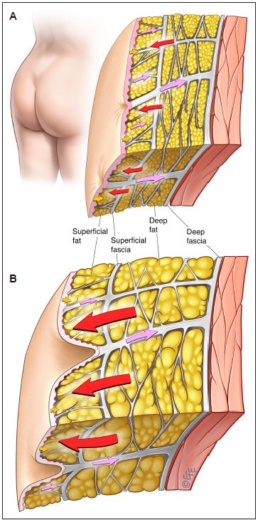 Cellulite eine architektonische Störung