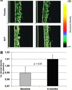 Dermisveränderung Kollagenpeptid Cellulite