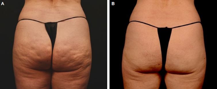 Subzision bei Cellulite